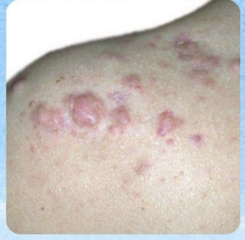 Cicatrices Queloides